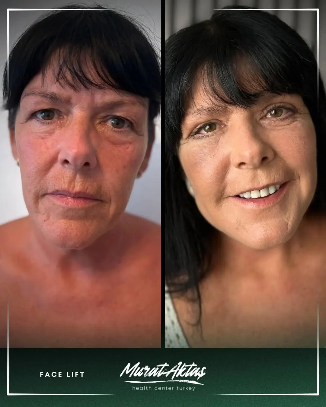 Face lift