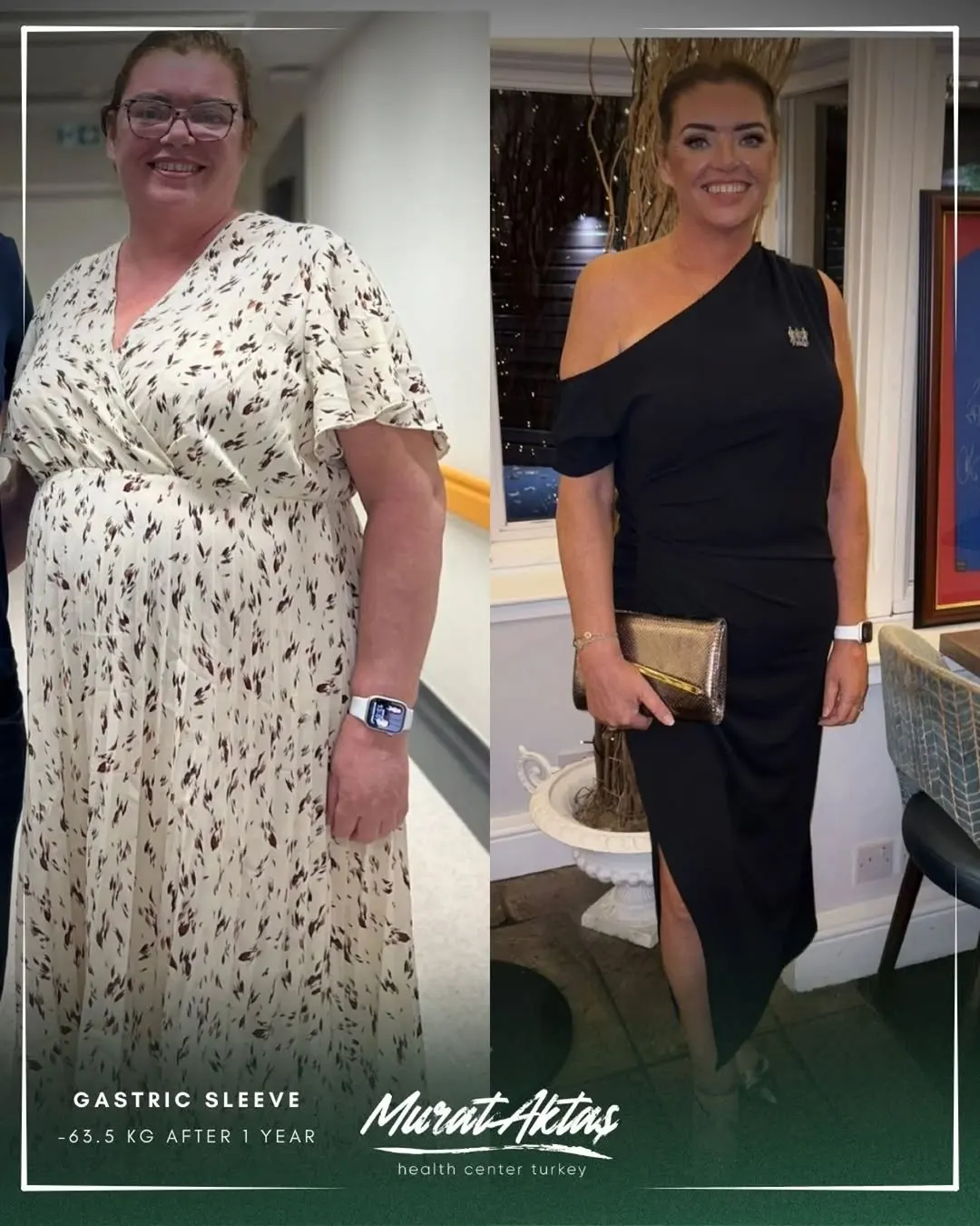 Gastric sleeve