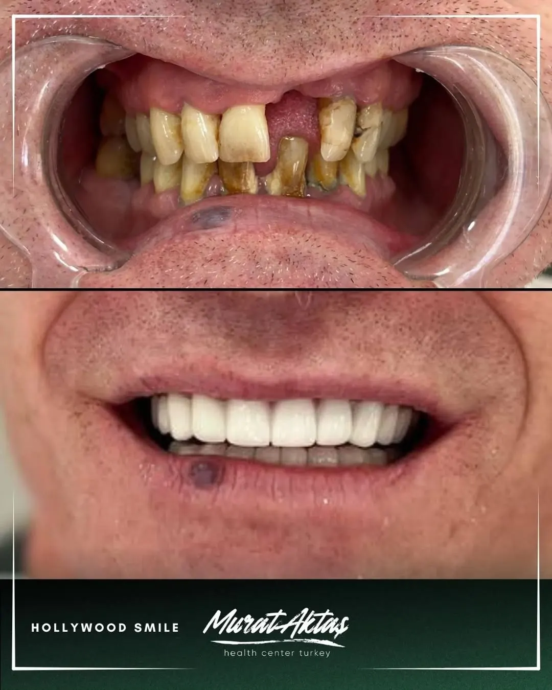 Hollywood smile