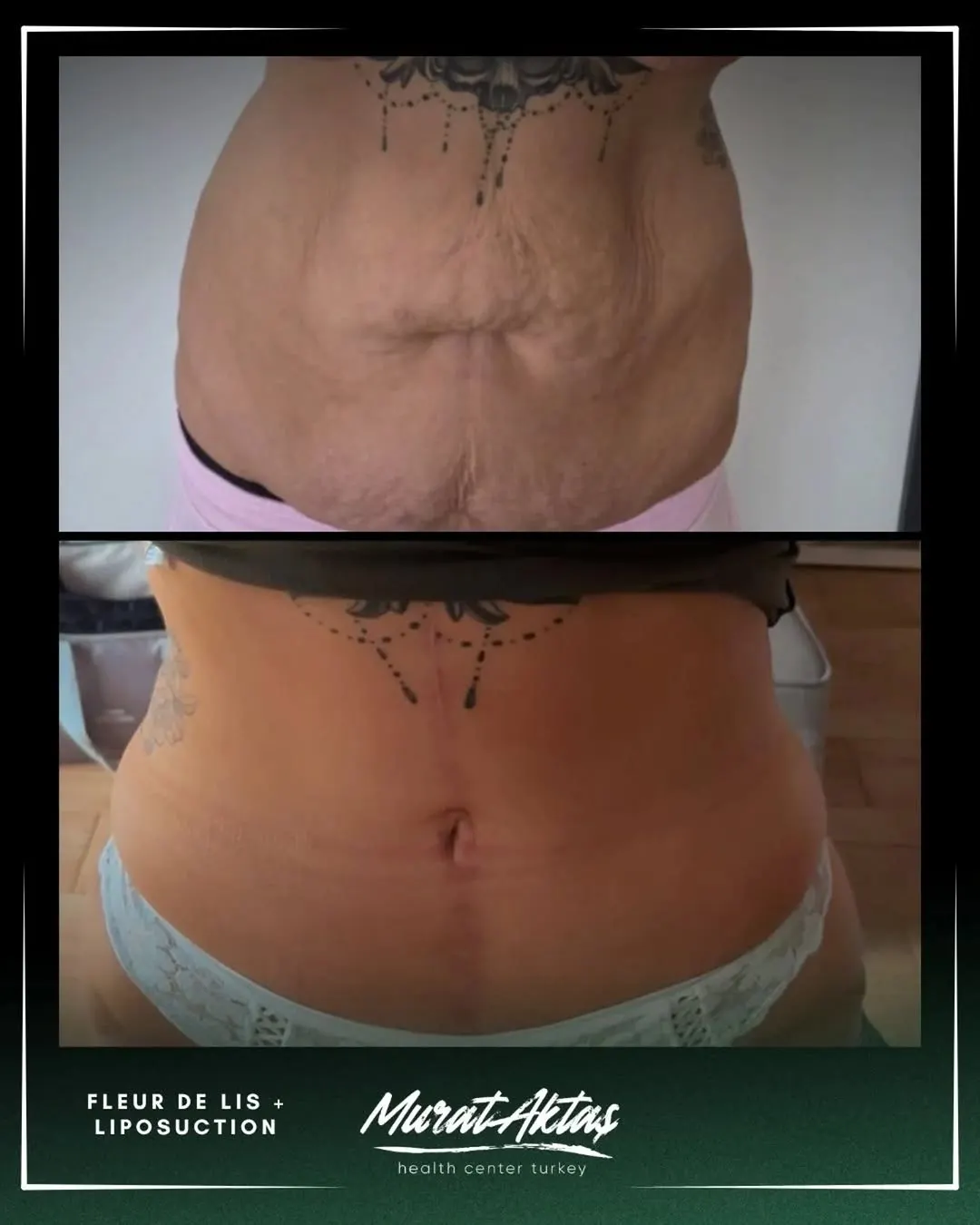Liposuction