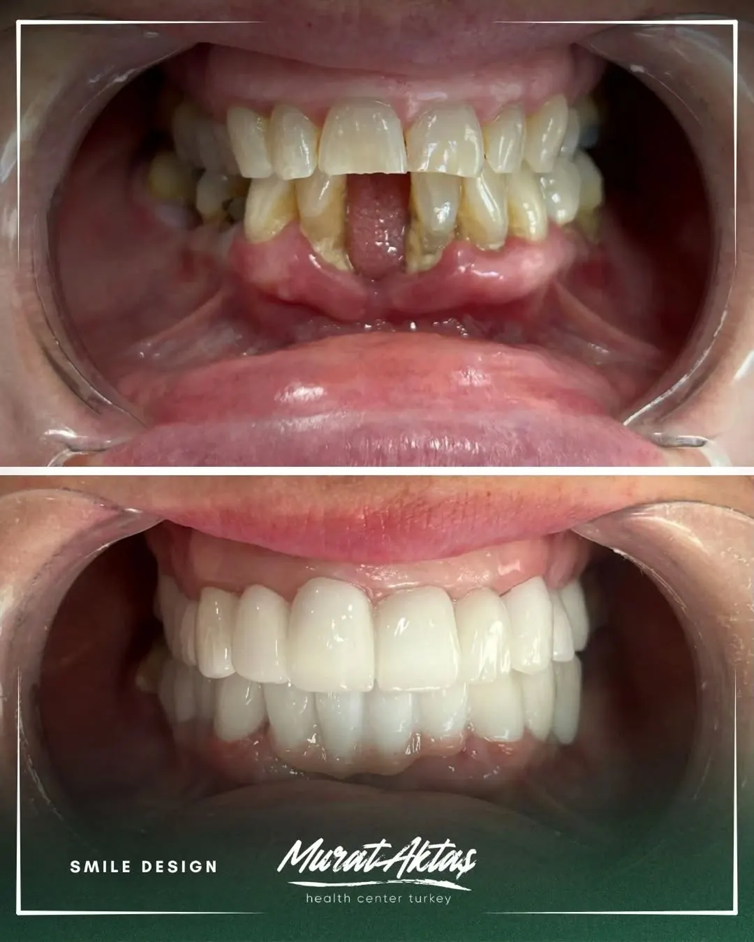 Smile design
