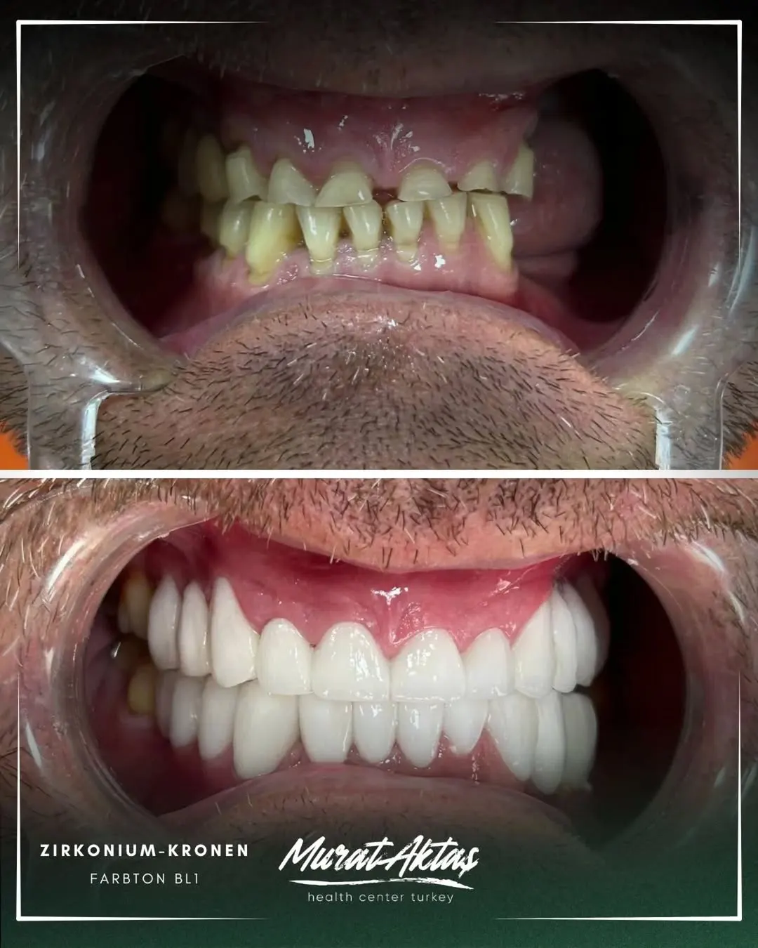 Zirconium crowns