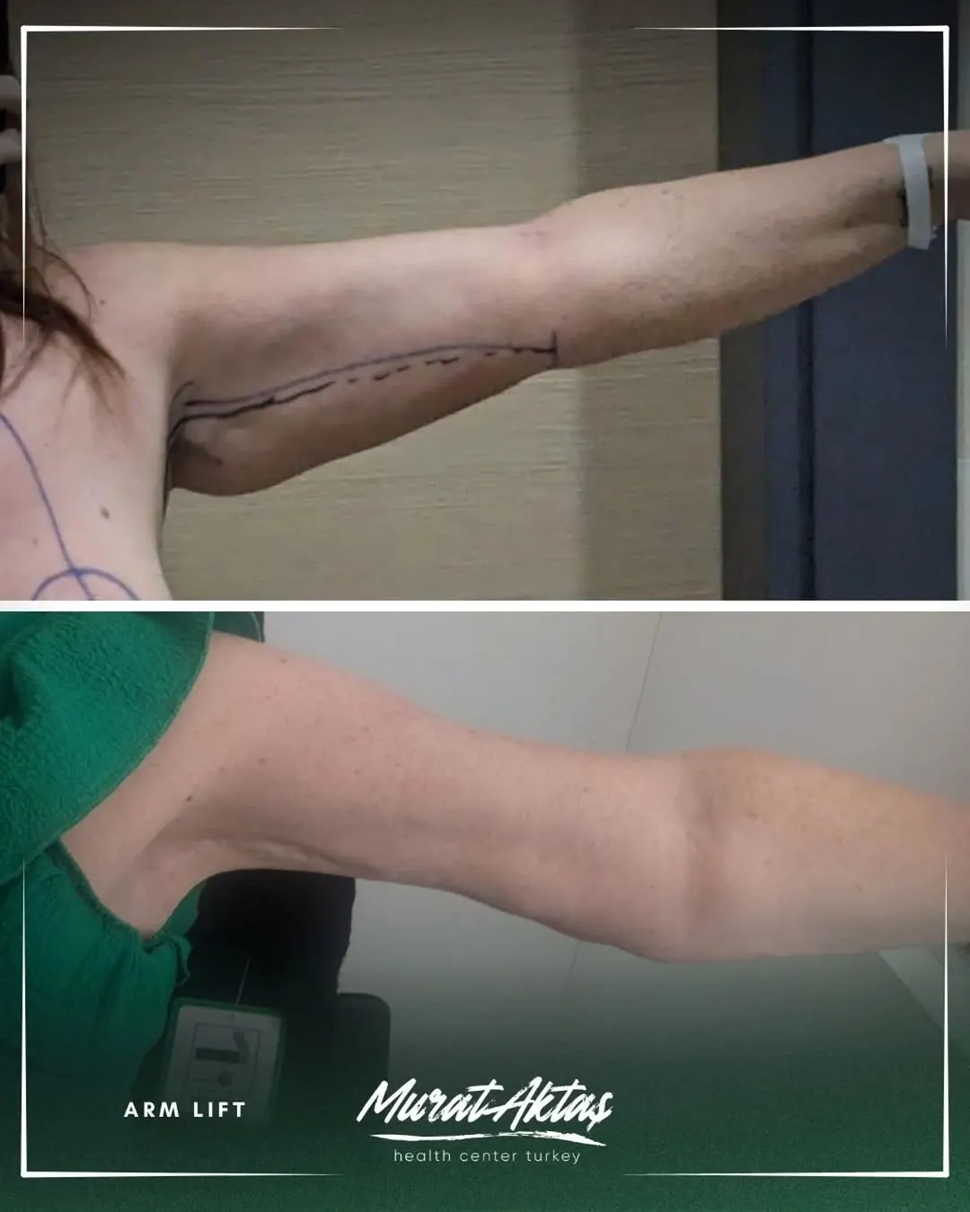 ARM LIFT