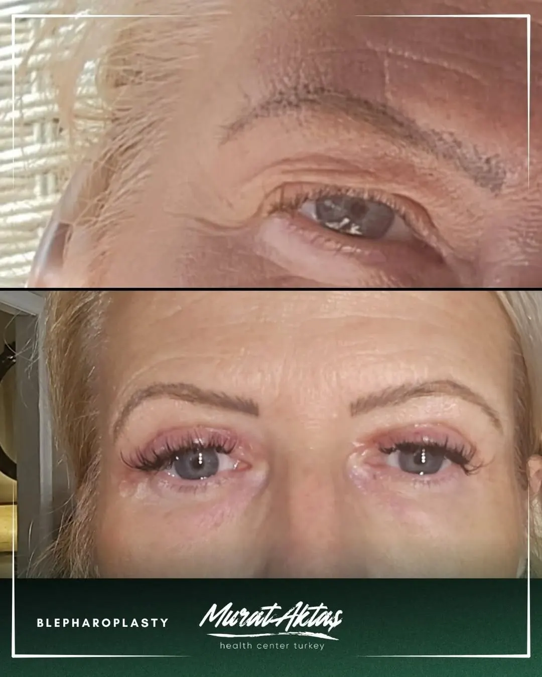 BLEPHAROPLASTY