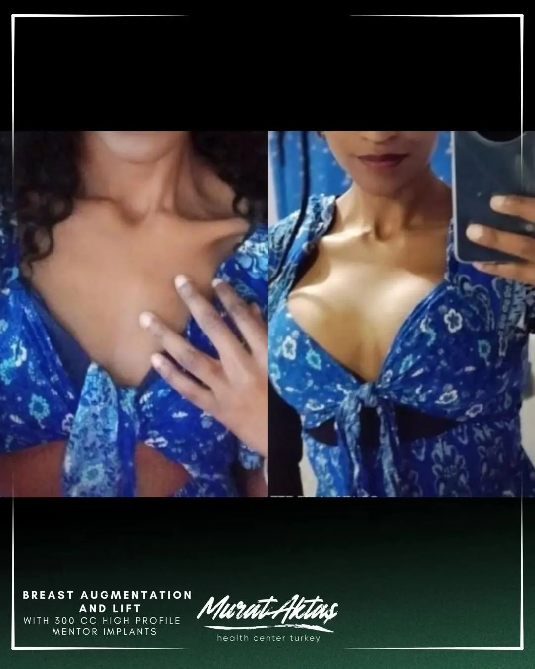 BREAST AUGMENTATION