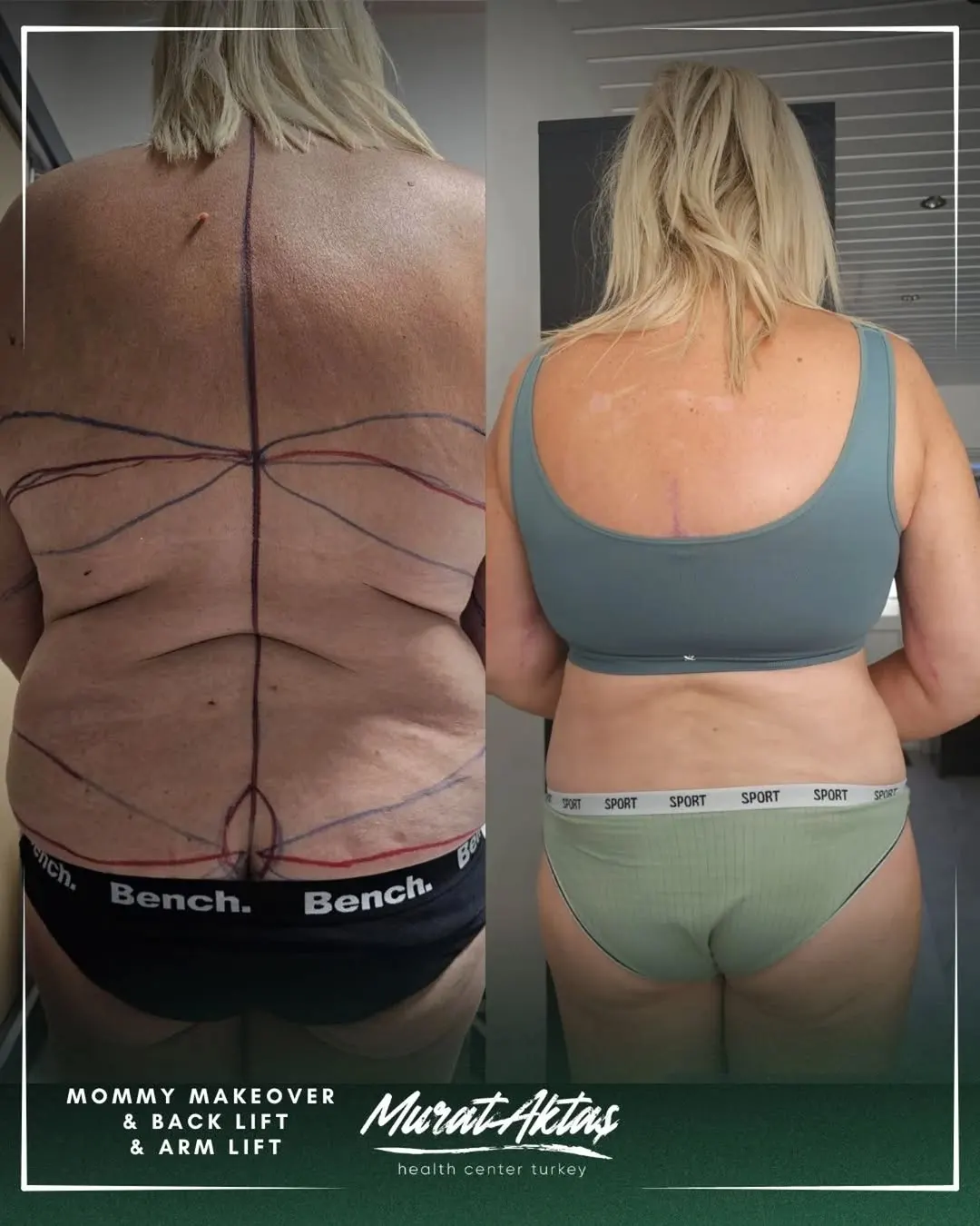 Mommy makeover