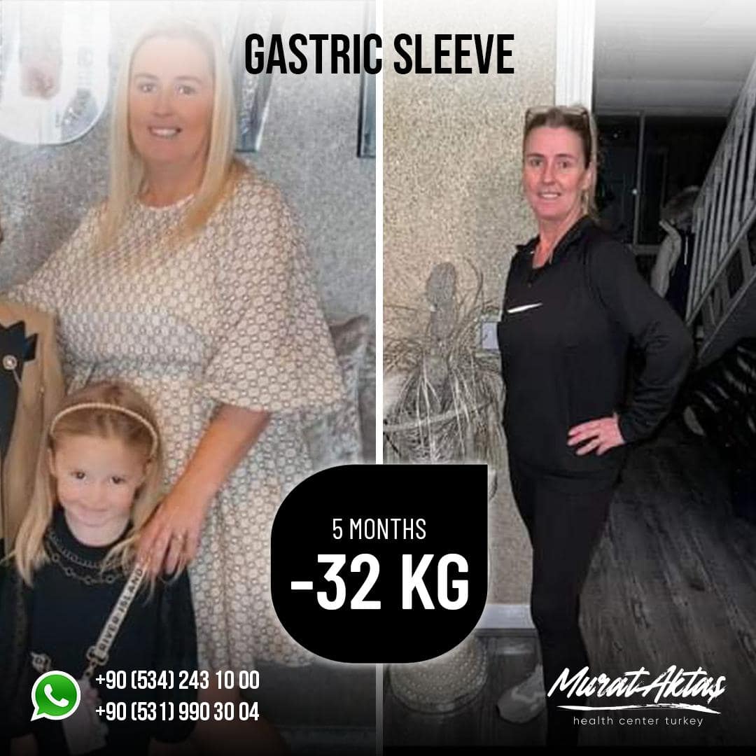 GastricSleeve128