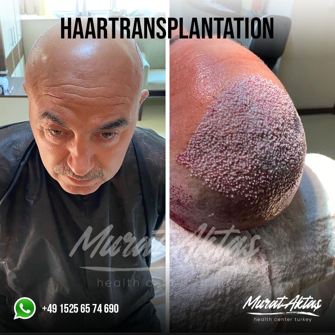 HairTransplant19